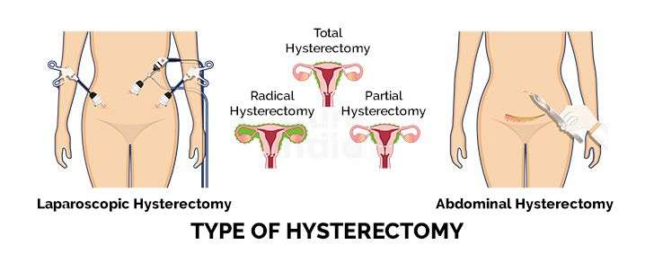 Laparoscopic Hysterectomy in India